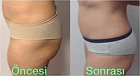 Bölgesel Zayıflama, İncelme Ankara