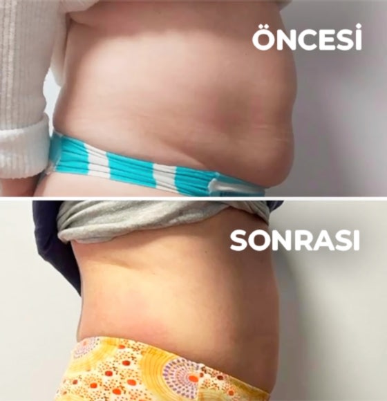 Bölgesel Zayıflama Göbek