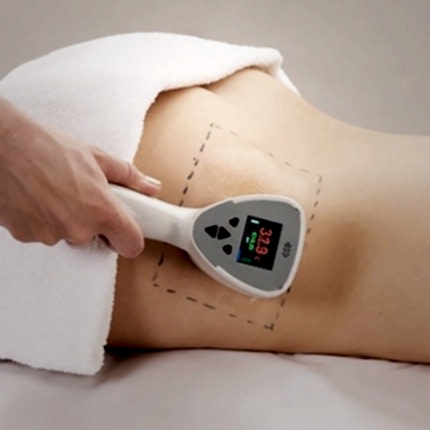 Exilis Ameliyatsız Estetik