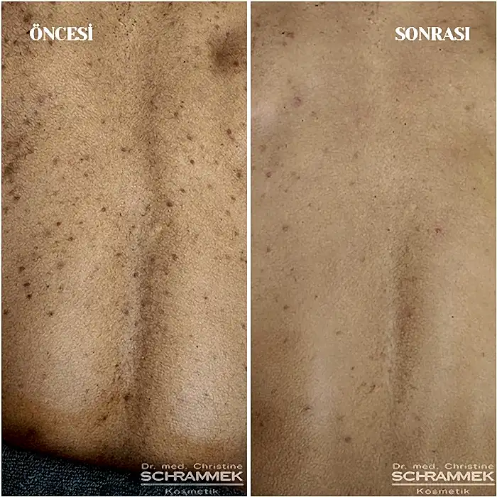 Green Peel Yaptıranlar