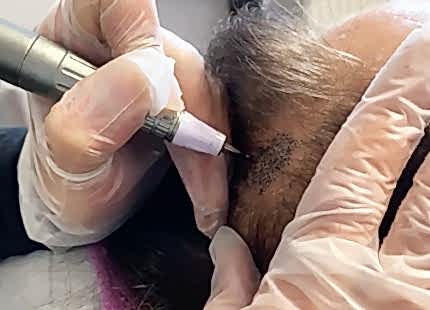 Saç Ekimi Sonrası Saç Simülasyonu