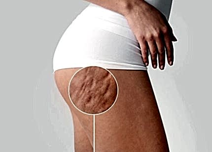 Selülit Nedir? Nasıl Geçer?